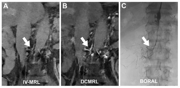 서울대병원, 혈관 주사만으로 림프관 확인하는 MRI 검사법 개발