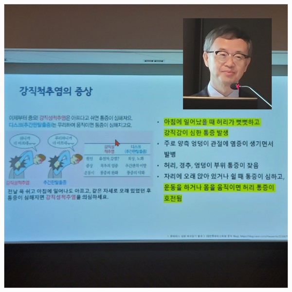 린버크, 강직척추염 보험급여 확대  NSAIDs/DMARDs 이후 경구 치료